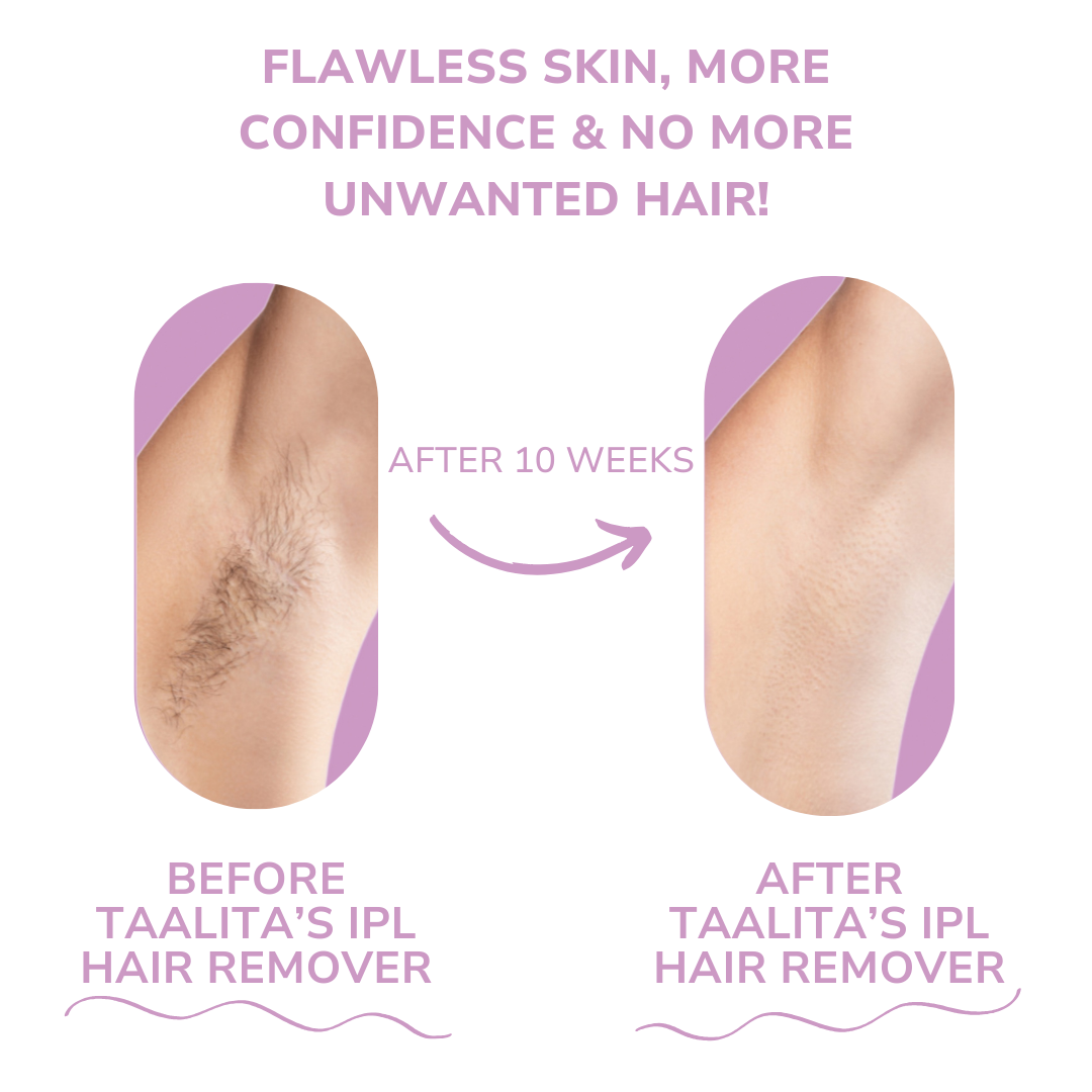 Glowvia IPL-ontharingsapparaat – Pijnloos & permanent voor thuisgebruik